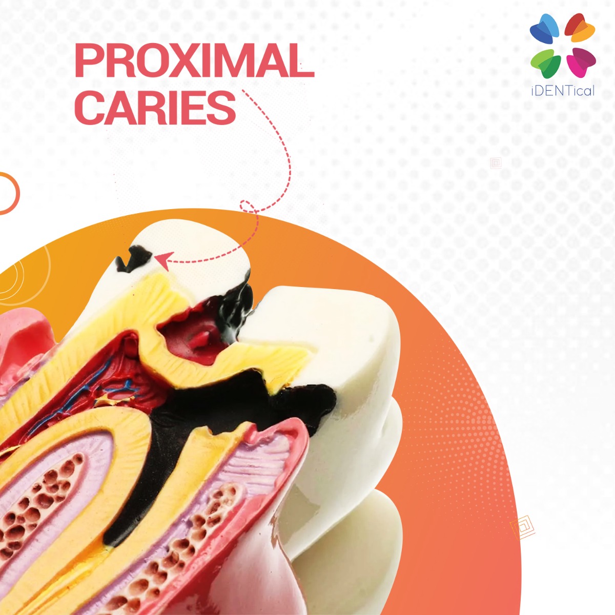 iDENTical Caries V/S Healthy Teeth Model M4021