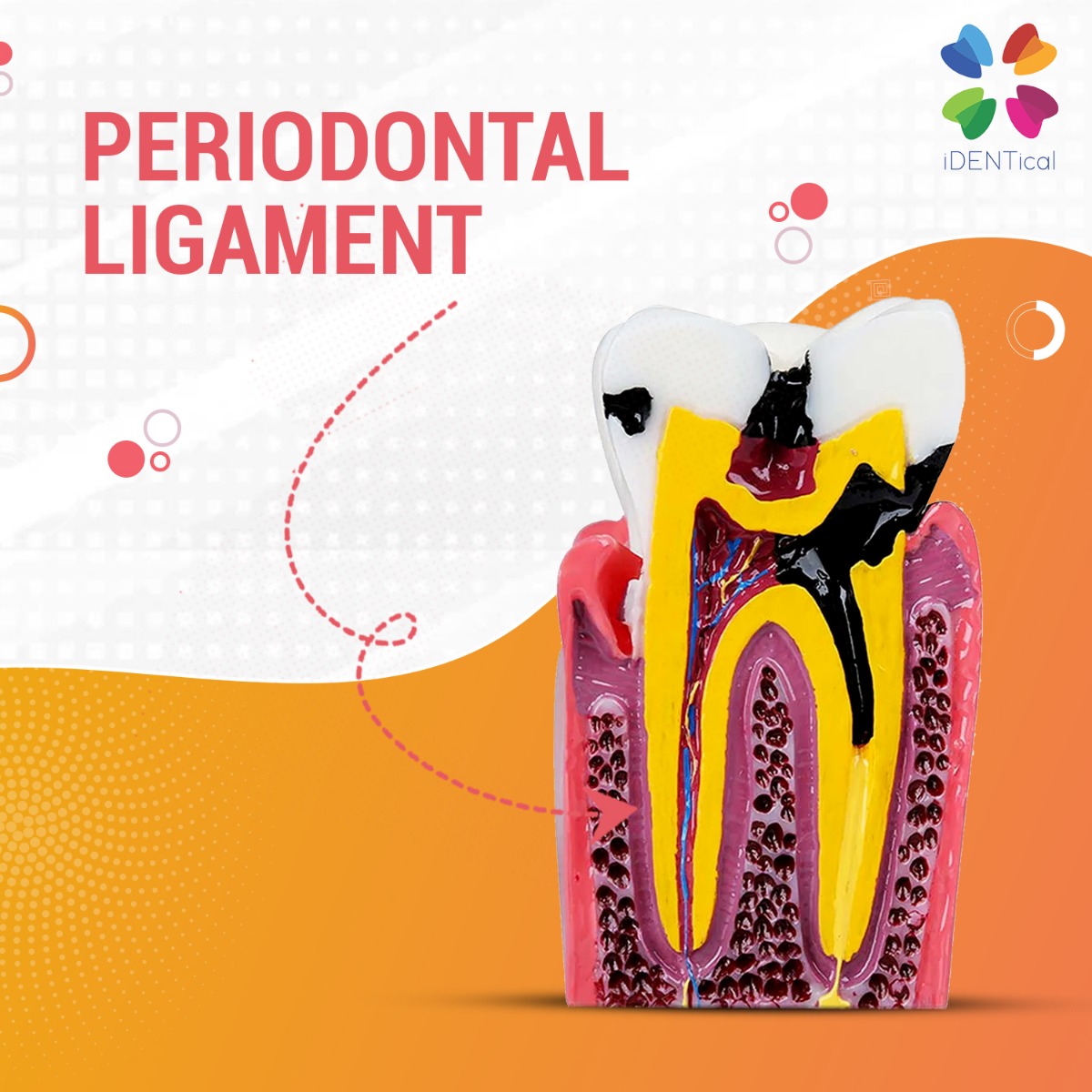 iDENTical Caries V/S Healthy Teeth Model M4021