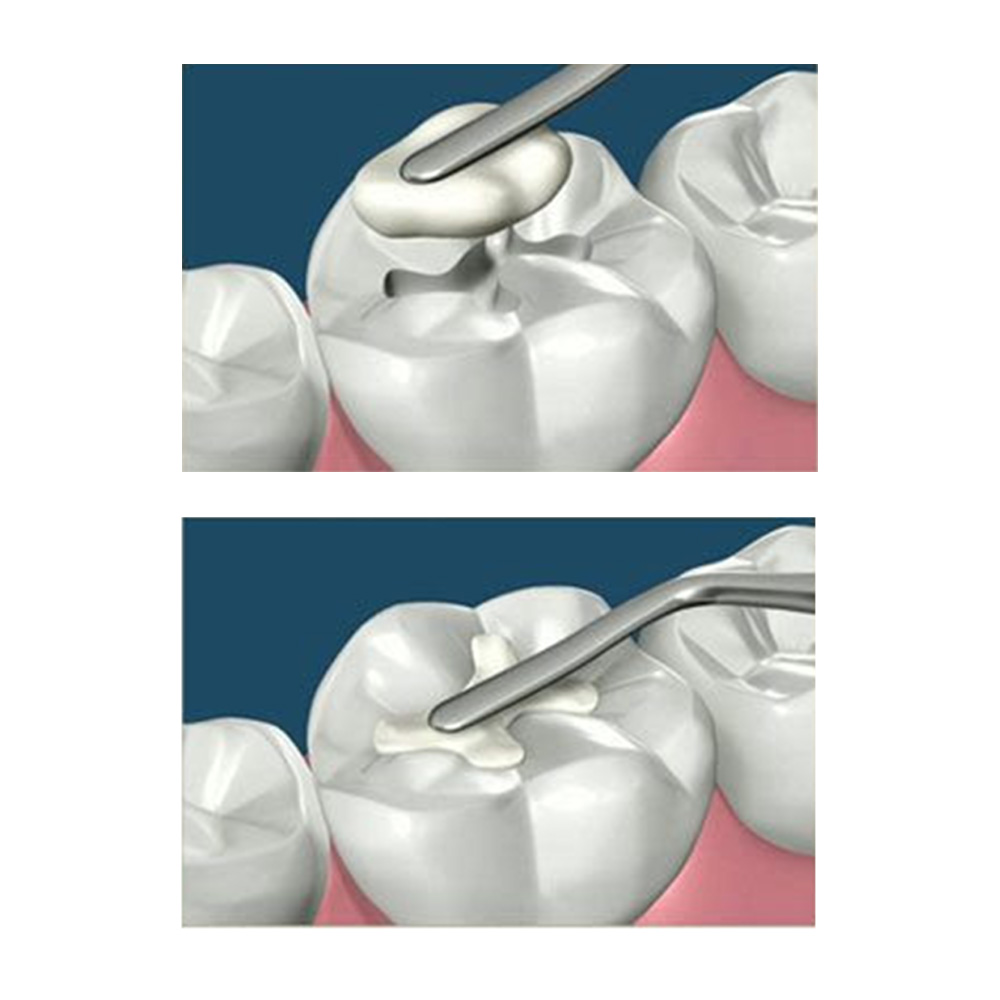 GDC Plastic Filling Instrument - 3 (PFGFT2)