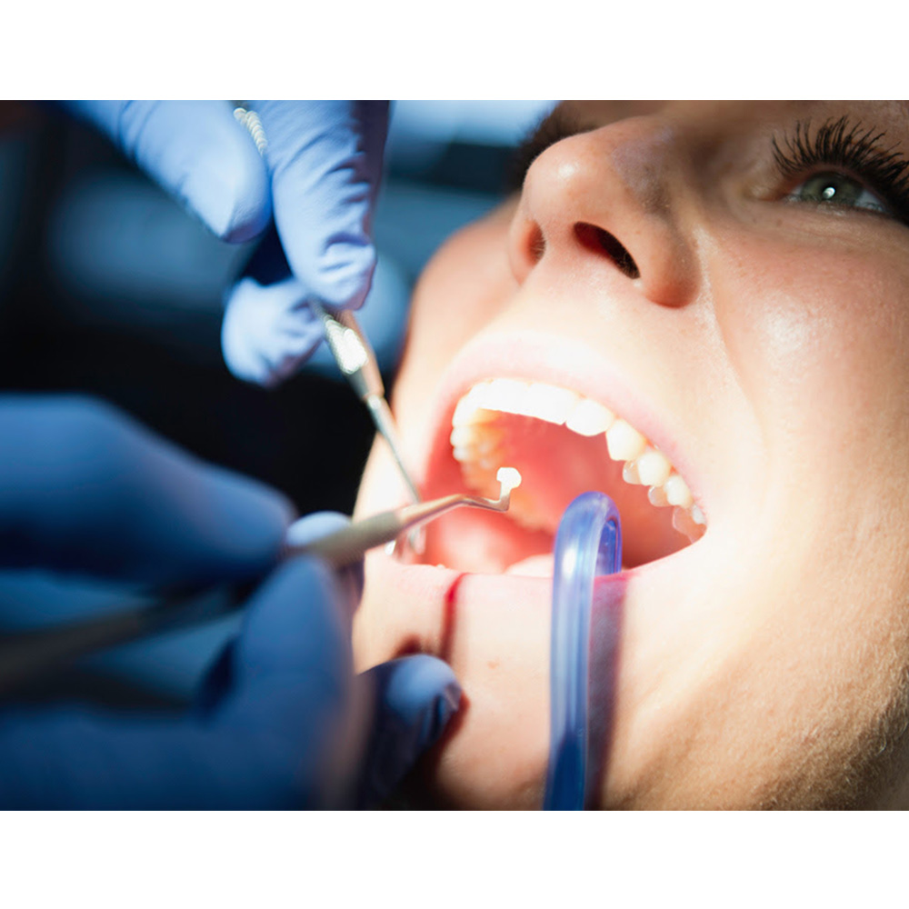 GDC Plastic Filling Instrument - 4 (PF21)