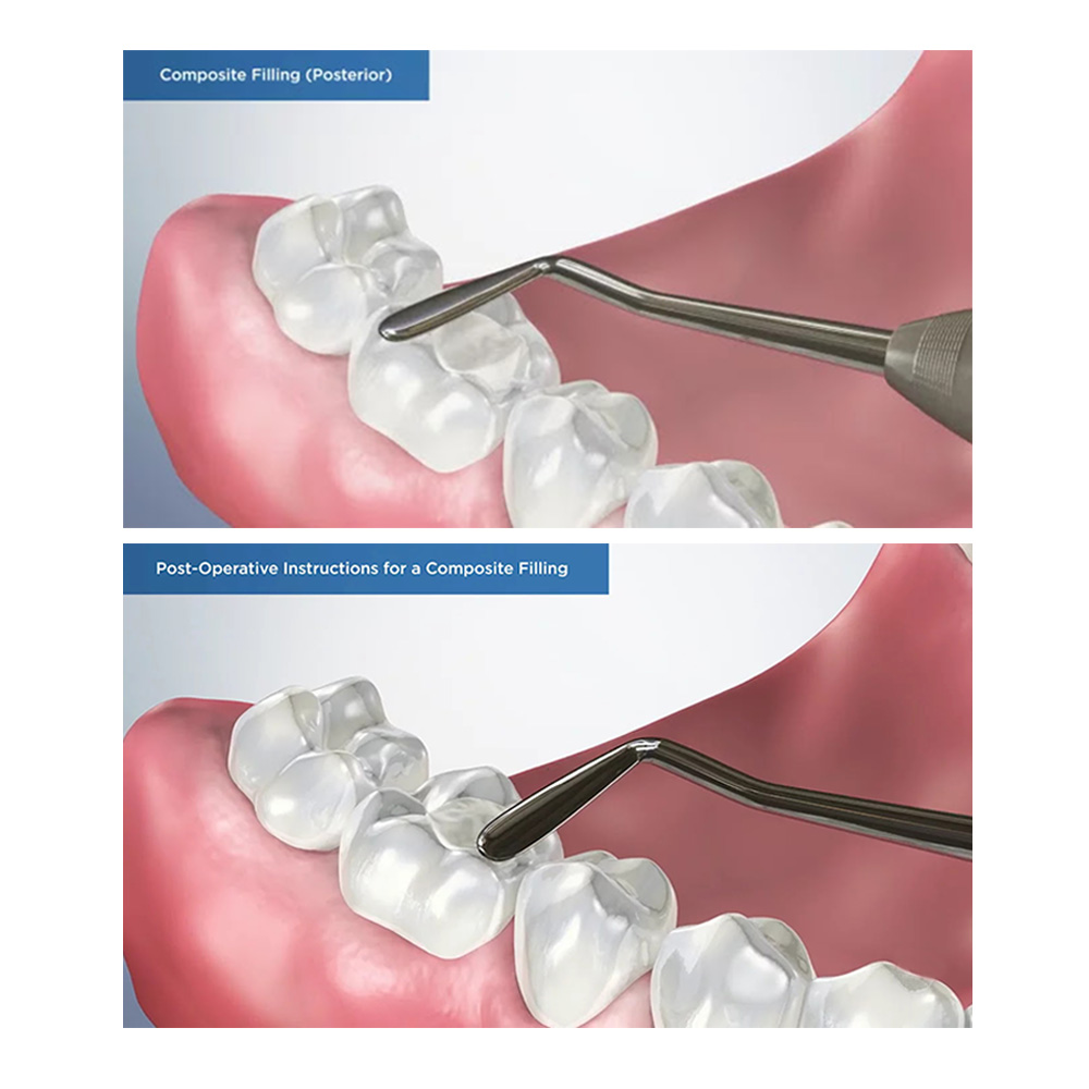 GDC Plastic Filling Instrument - 4 (PF2)