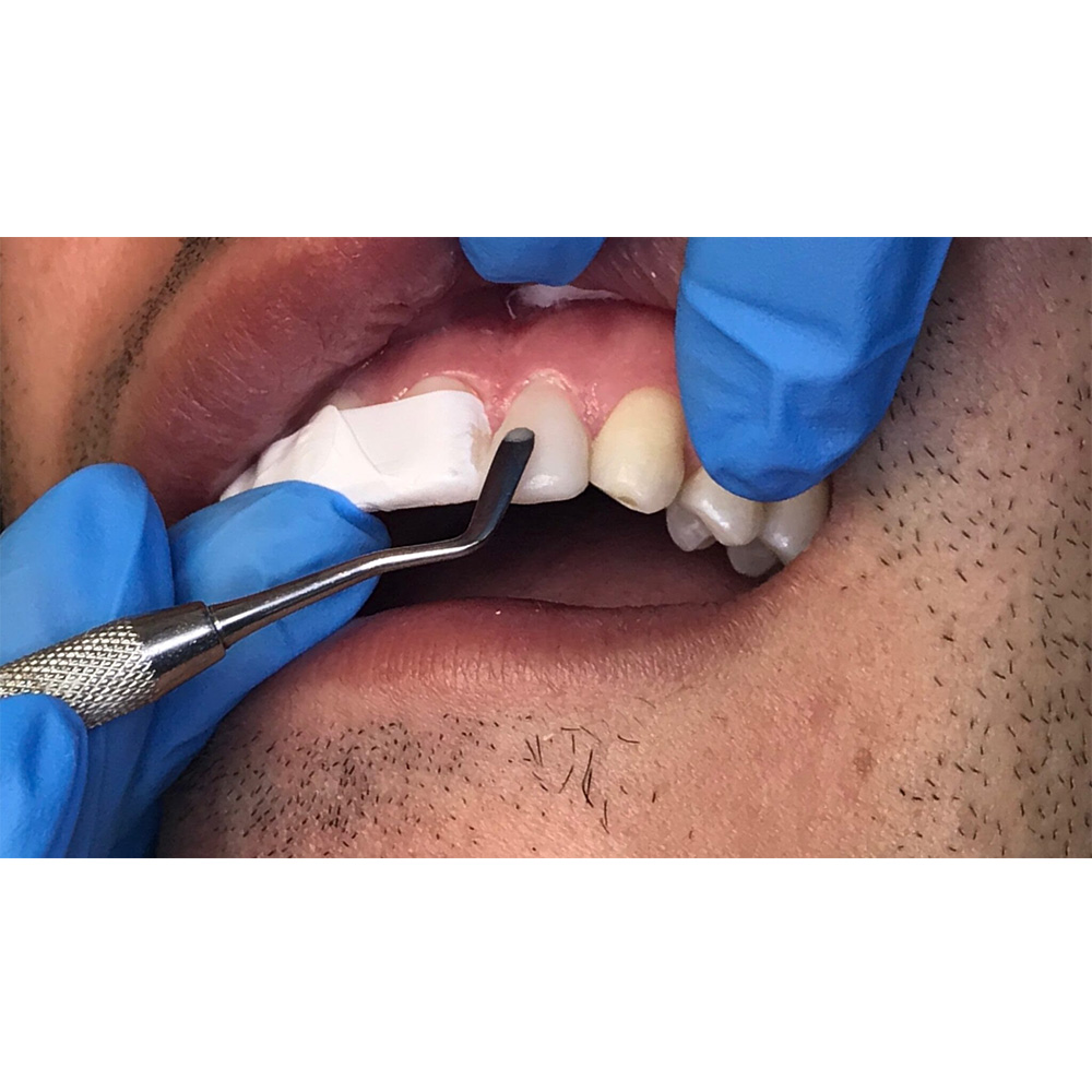 GDC Plastic Filling Instrument - 3 (PFGFT1)