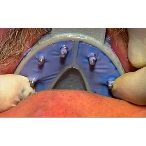 Cotisen Implant Impression Tray Insert Refills