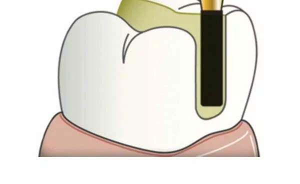 Frank Dental Cylinder Round Edge Diamond Burs SRS Series (Regular)