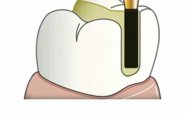 Frank Dental Cylinder Flat End Diamond Bur SF Series (Regular)