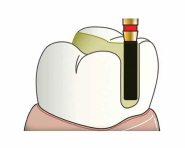 Frank Dental Cylinder Round Edge Diamond Burs SRS Series (Fine)