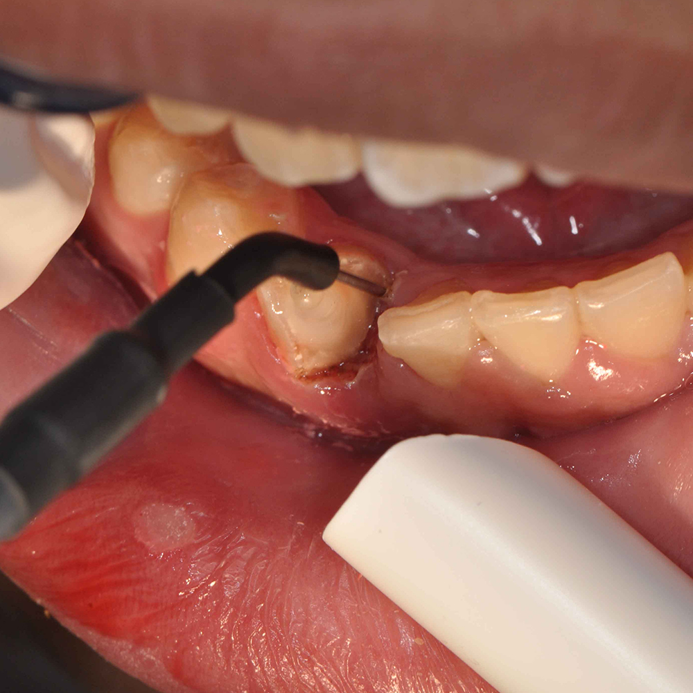 HN Dental R.F. Smart Cautery