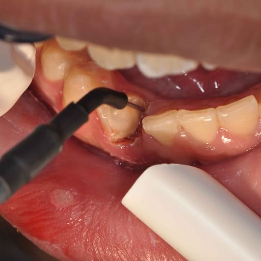 HN Dental R.F. Smart Cautery