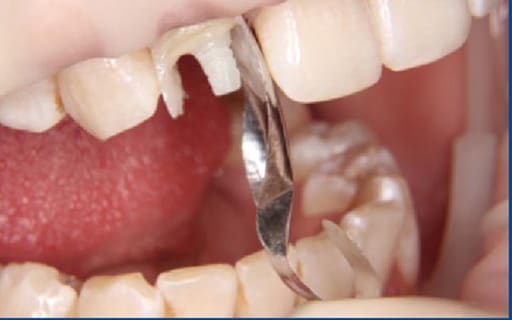 Tor Vm Anterior Metal Matrices and Strips