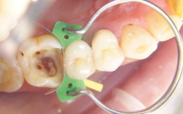 Tor Vm Sectional Contoured Matrices Kits