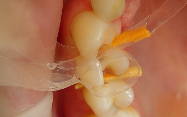 Tor Vm Transparent Contoured Matrices for Premolars & Molars