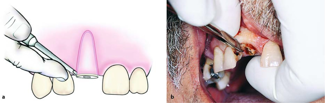 Waldent Root Elevator Instruments Kit Set of 11 K2/4