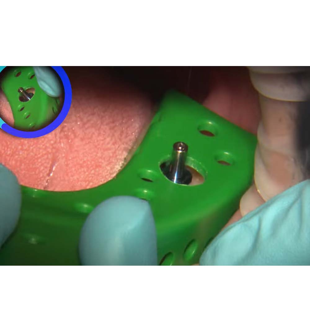 Xcem Conical Pick Up Impression Coping - Hex 4.8mm x 10mm (XCAICP-4810H)