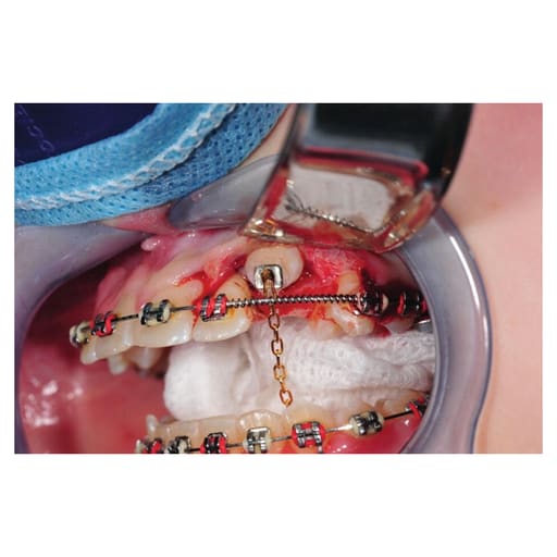 JJ Ortho Button And Chain Eruption Appliance (60.01.69E)