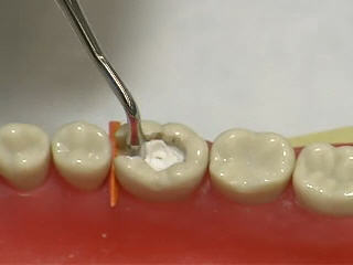 Ammdent Zinogen Zinc Oxide Eugenol Cement