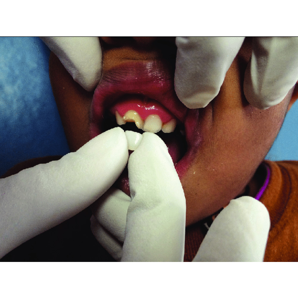 Kids-e-Dental BioFlx Central Incisor Crowns Refills