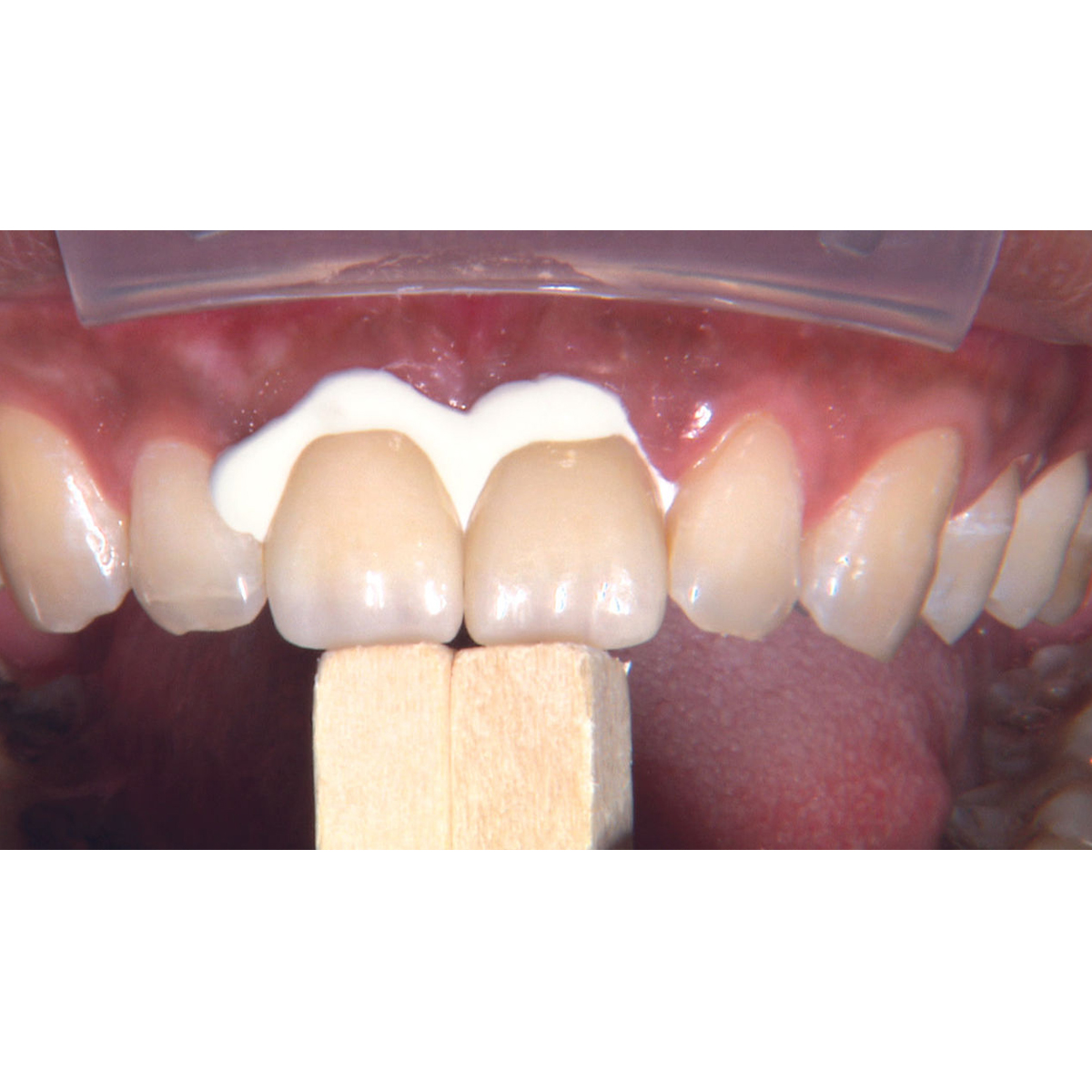 Kids-e-Crown Zirconia Universal Upper Central Incisor Refills