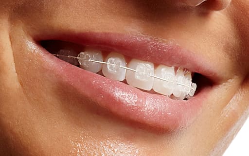 U Ortho SS Tooth Color Wire - Rectangular (Pack of 1)