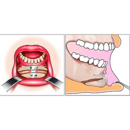 SK Surgicals Titanium Mini Chin Plates 2mm - 2