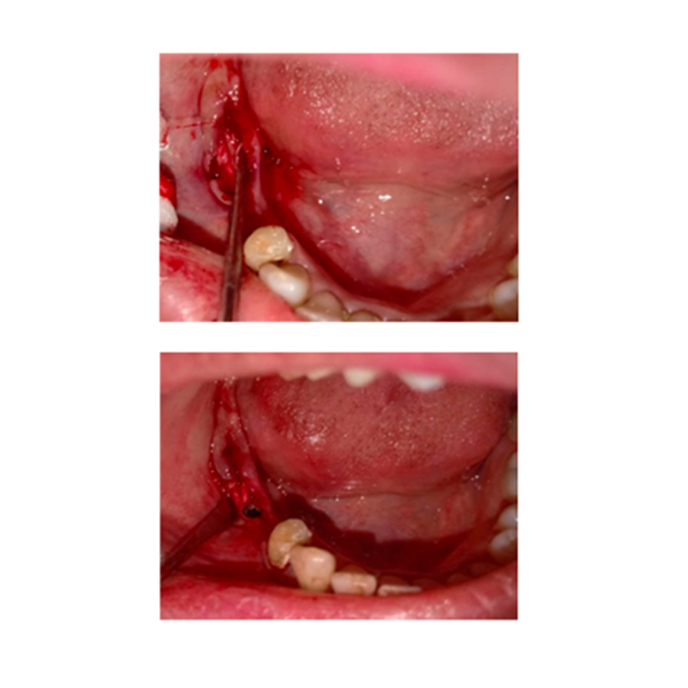 GDC Bone Chisel Gardner (3mm) (CG1)