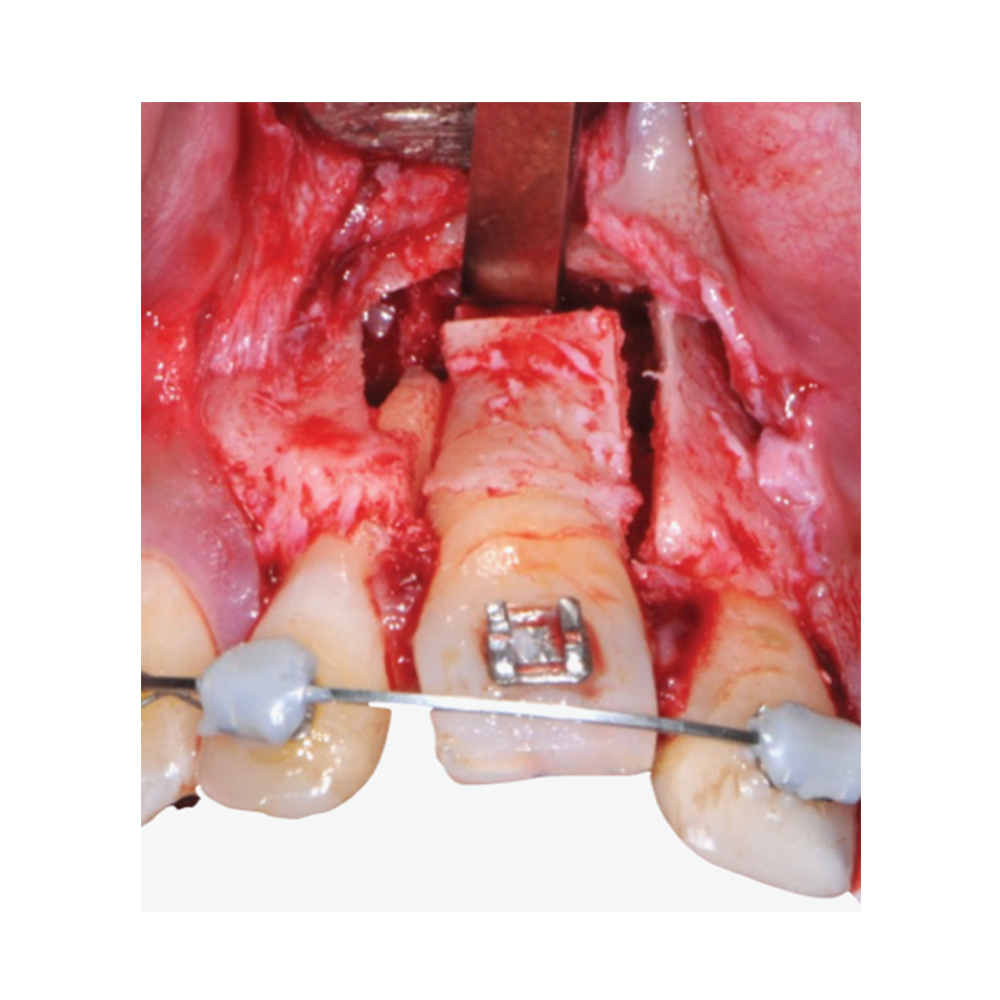 Waldent Gardner Bone Chisels