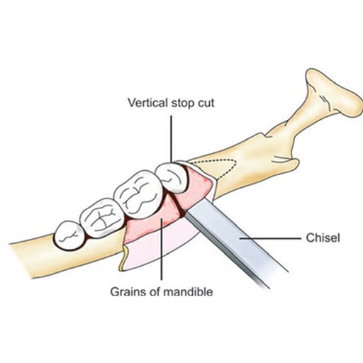 Oracraft Chandler Bone Chisel - 7mm (CC9)