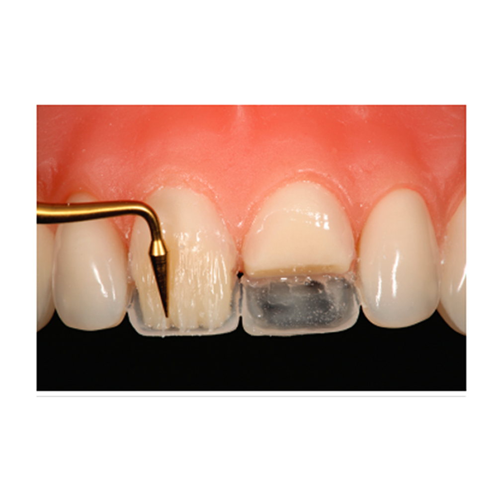 GDC Composite Instrument Gold Titanium - 6 CIG3