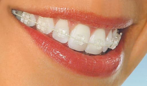 U Ortho SS Tooth Color Wire - Rectangular (Pack of 1)