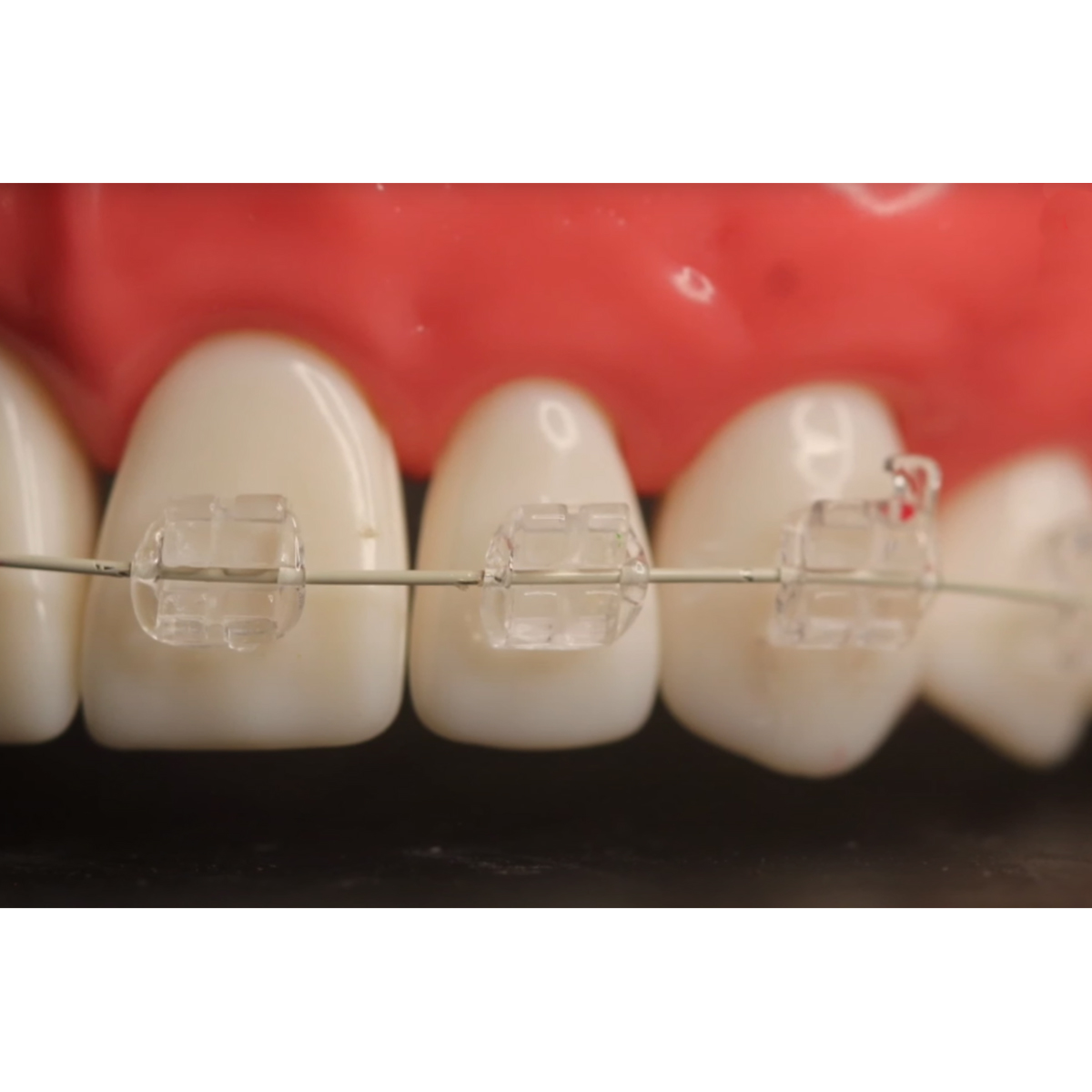 Koden Clear HD MBT Bracket Kits