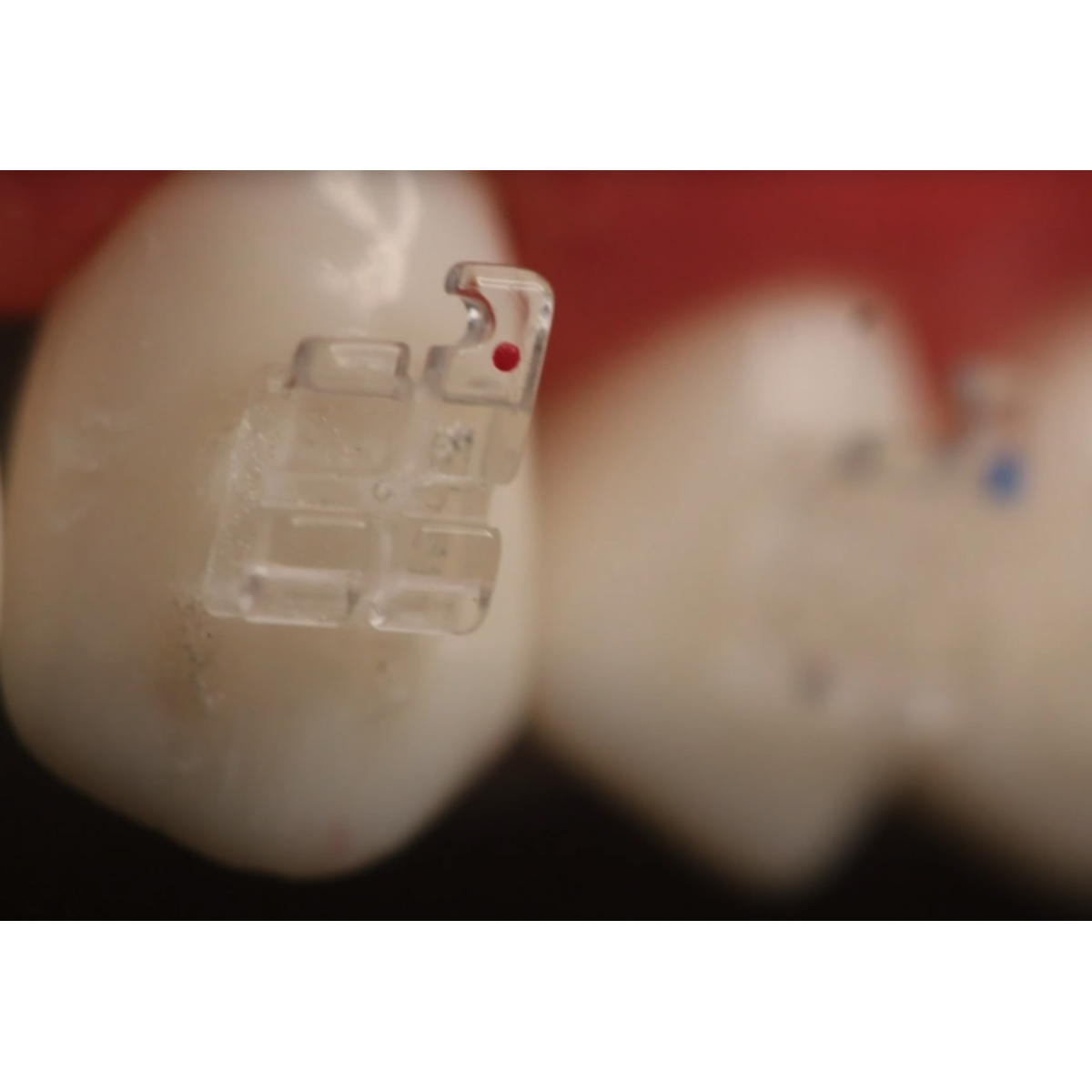 Koden Clear HD MBT Bracket Kits