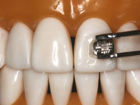 Anabond Orthofix Light Cure Adhesive Kit