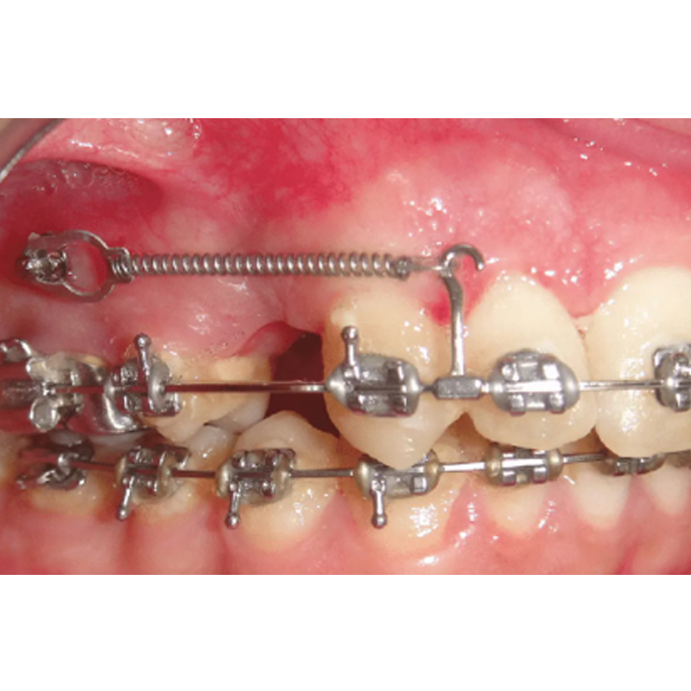 Koden NiTi Closed Coil Spring (Pack of 10)