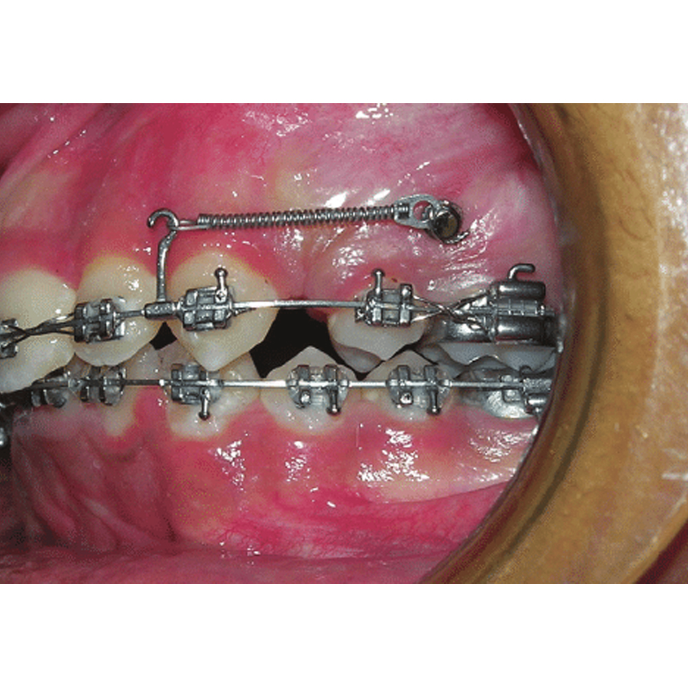 OSL NiTi Closed Coil Springs 0.010 (Pack Of 10)