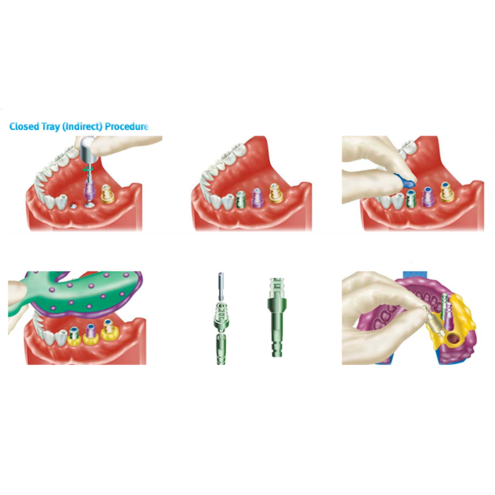 Adin CloseFit NP Slim Close Tray Transfer Impression Coping 3.2mmD x 13mmL (NP5113)