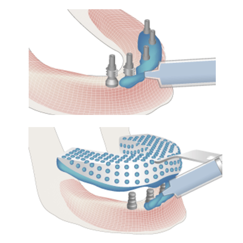 Adin CloseFit NP Slim Close Tray Transfer Impression Coping 3.2mmD x 13mmL (NP5113)