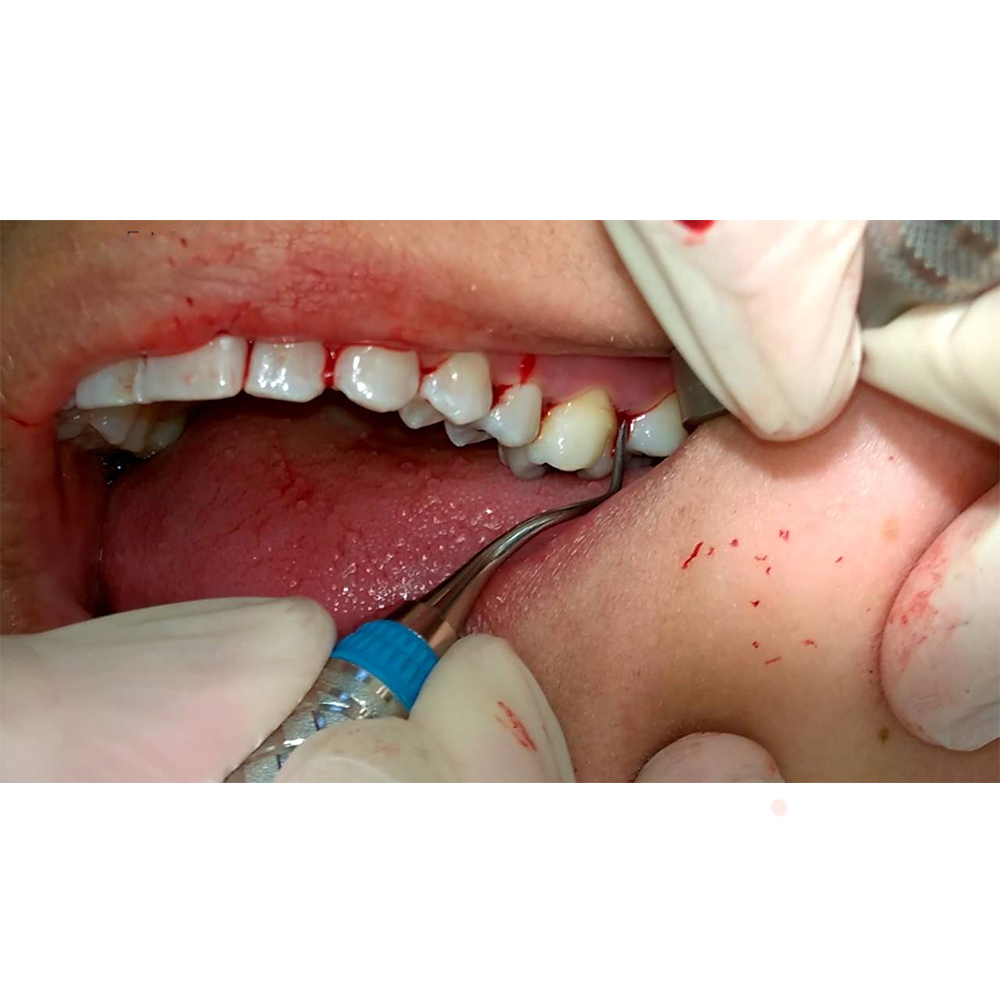 GDC Gracey Curettes Colour Coded Set of 7 In Pouch - GCCCP7#7