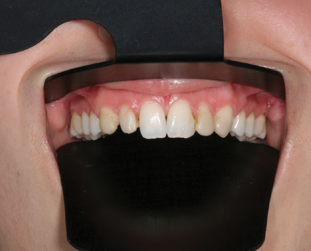 Capri Contrastors Set 3/pk