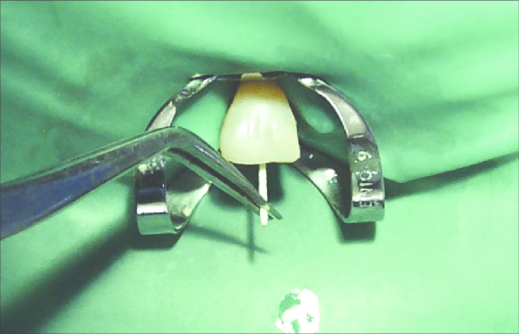 Sure Endo Paper Points