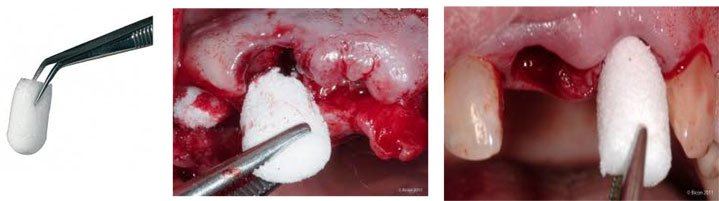 Cologenesis ColoPlug Sterile Collagen Sponge - Pack of 1