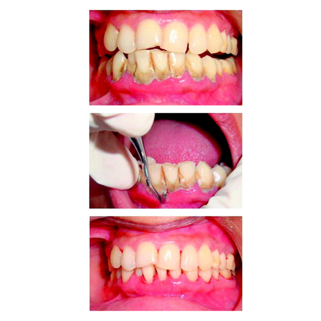 GDC Columbia Curette Color Coded # 2r/2l # 7 (Sccc2r/2l)