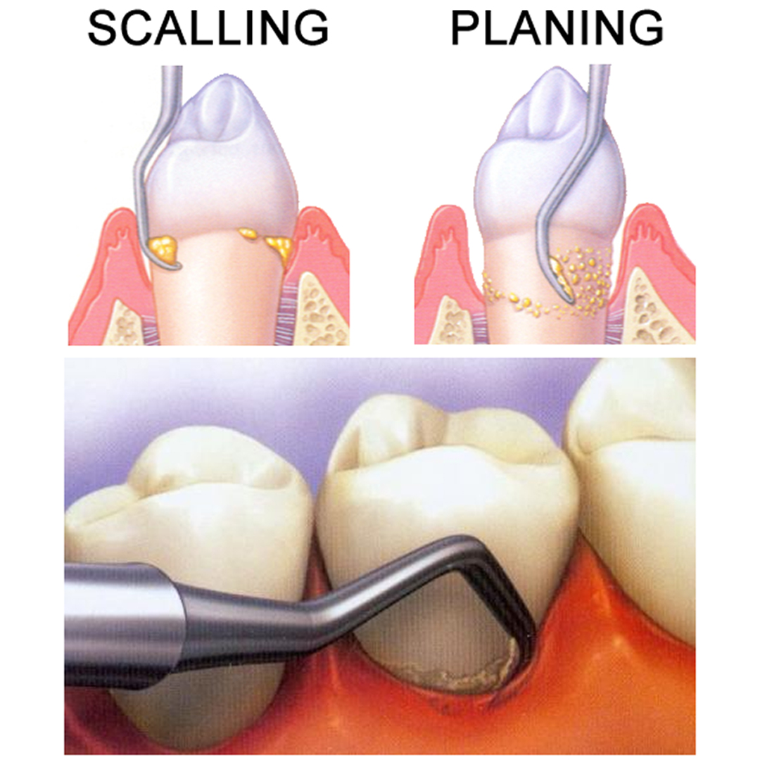 GDC Columbia Curette - Color Coded # 4r/4l # 7 (Sc4r/4l) 