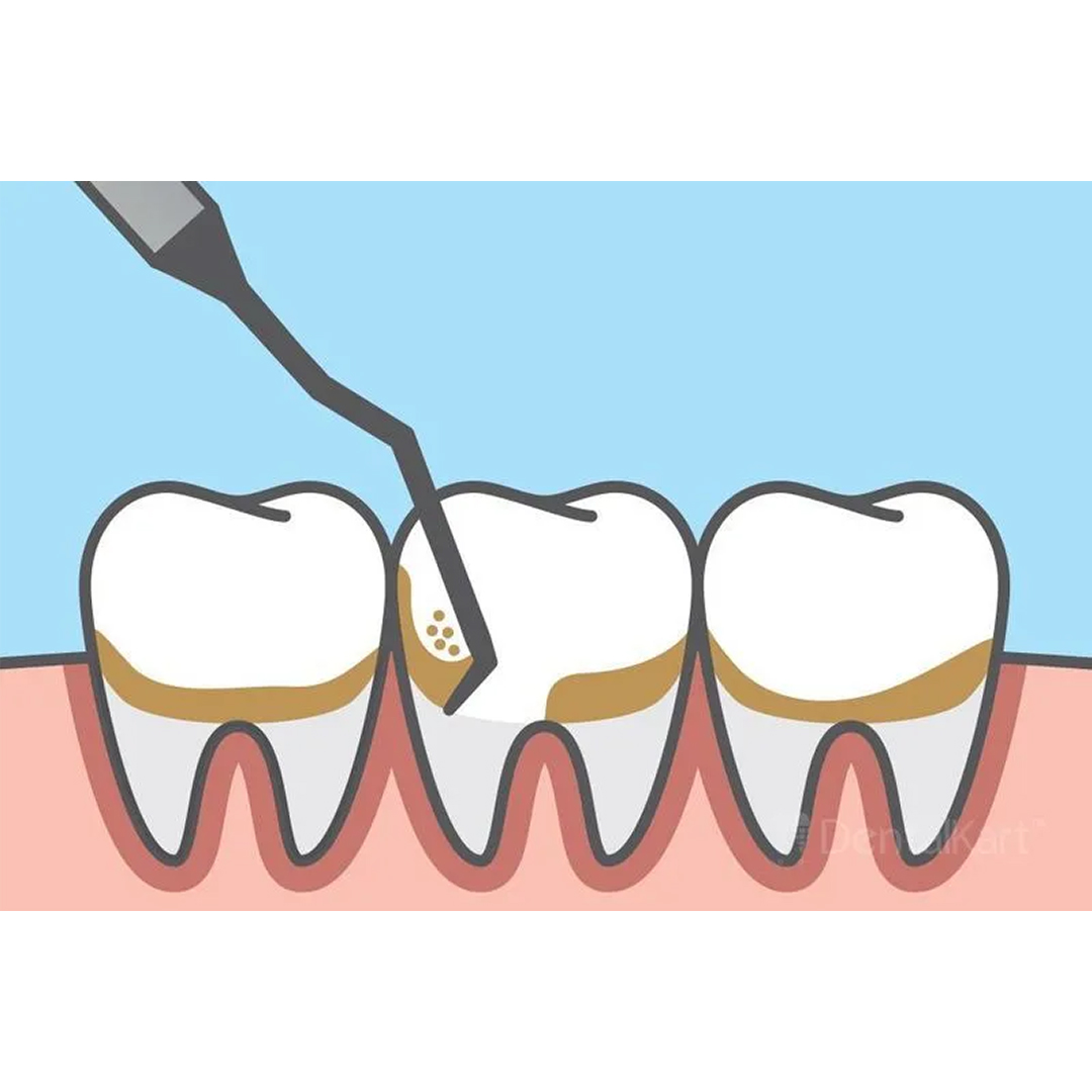 GDC Columbia Curettes 4r/4l Posterior Application #6 (Sc4r/4l)