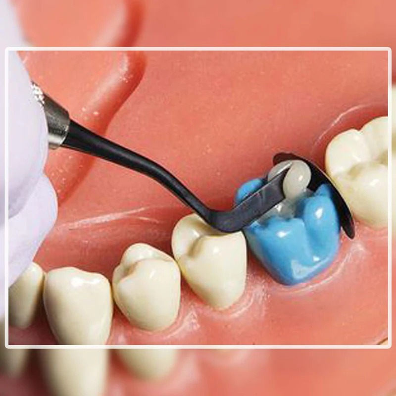 GDC Plasma Coated Black Composite Posterior Medium / Large Contact (TNCFIM/L)