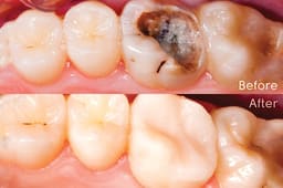 SafeEndo ReCreate LC - 6