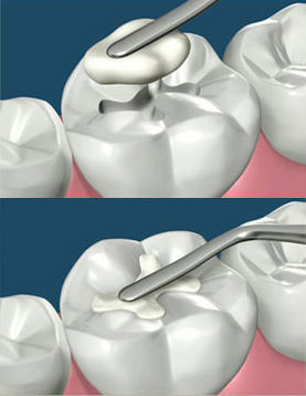 Dentsply Spectrum Composite Kit