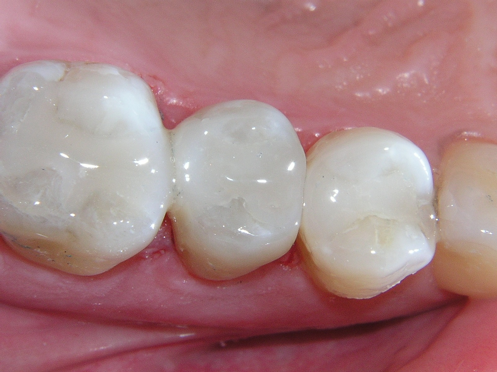 Medicept Dental Flow Plus Composite 