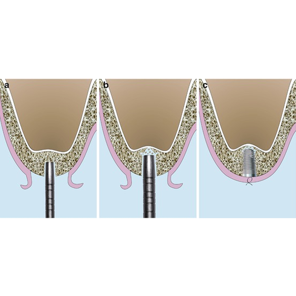 GDC Osteotomes Concave - Angulated (Ostmsh37a)