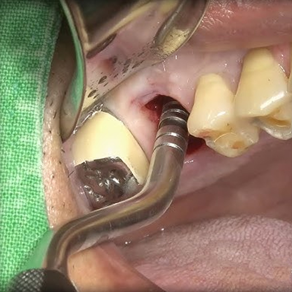 GDC Osteotomes Concave - Angulated (Ostmsh47a)