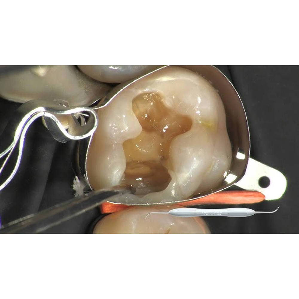 GDC Restore Instrument - Condensa