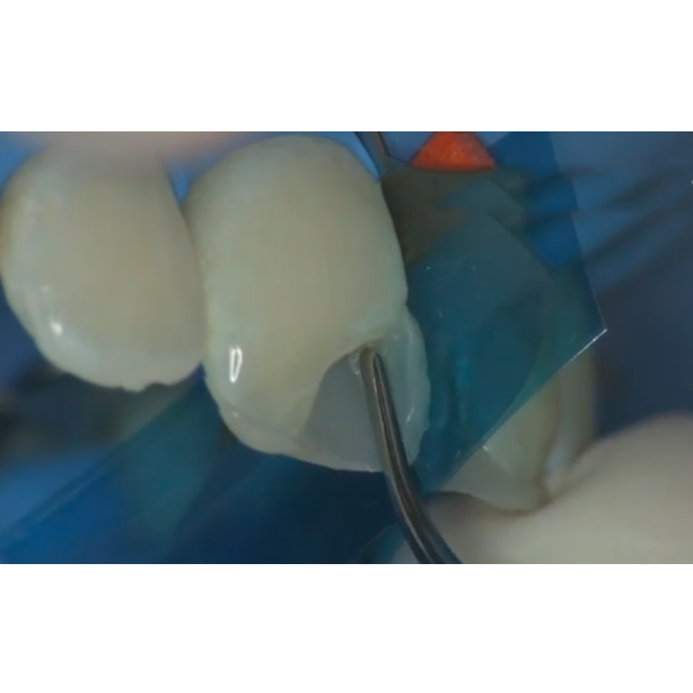 GDC Restore Instrument - Condensa